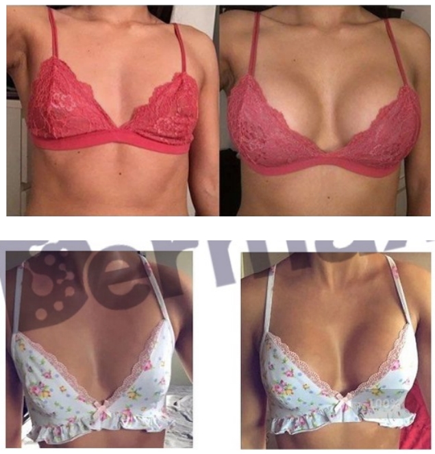 Inyecciones de ácido hialurónico para senos