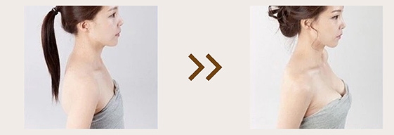 aumento de pecho con ácido hialurónico precio aumento de pecho con ácido hialurónico precio