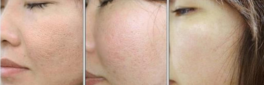 Skin texture improvement after PDRN skin booster treatment Skin texture improvement after PDRN skin booster treatment