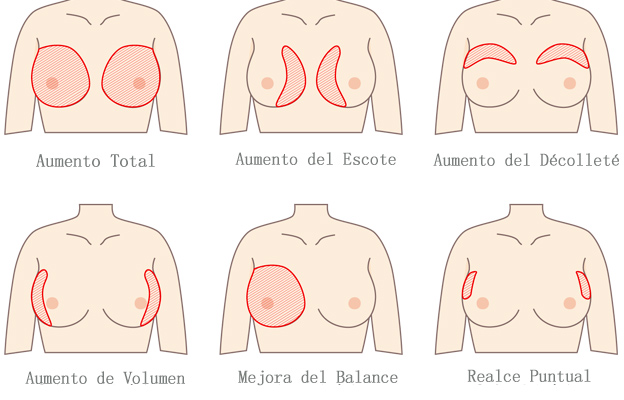 ácido hialurónico en senos antes y después ácido hialurónico en senos antes y después