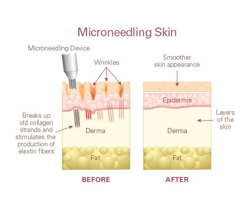 microneedling con exosomas microneedling con exosomas precio