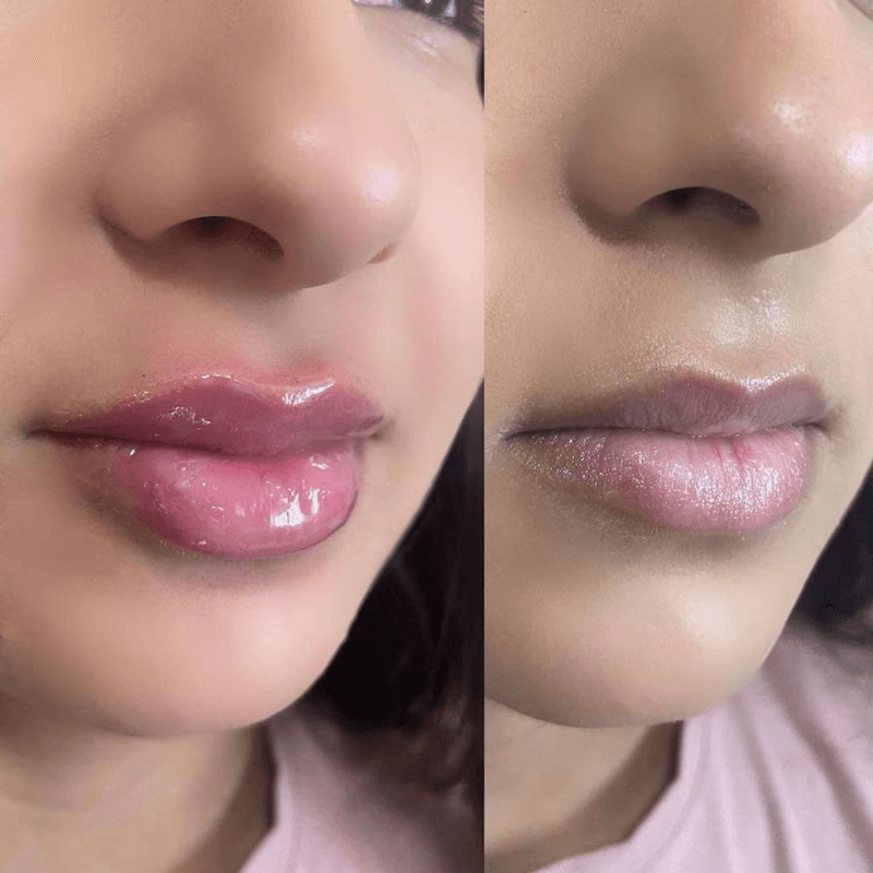 Relleno Labial Con Ácido Hialurónico Precio Relleno Labial Con Ácido Hialurónico Precio