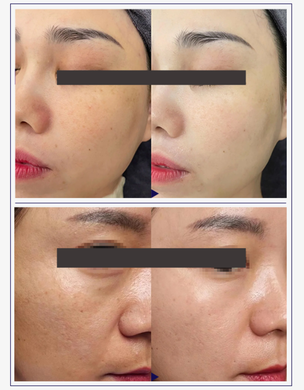 inyección de colágeno inyección de colágeno