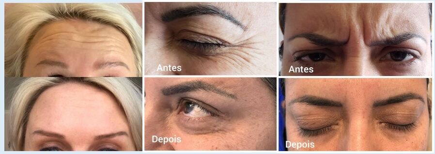 toxina botulínica tipo A para arrugas faciales