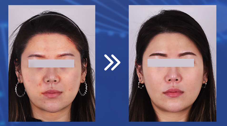 Inyecciones De Polinucleótidos Inyecciones De Polinucleótidos