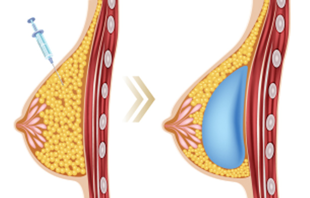ácido hialurónico en senos antes y después ácido hialurónico en senos antes y después