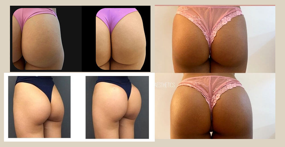 Ácido Hialurónico Inyectable en Glúteos Precio Ácido Hialurónico Inyectable en Glúteos Precio