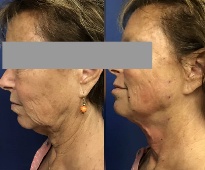 los mejores hilos pdo para lifting