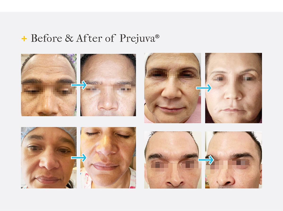 Antes y después de prejuva H + L 3.2 64mg 2 ml