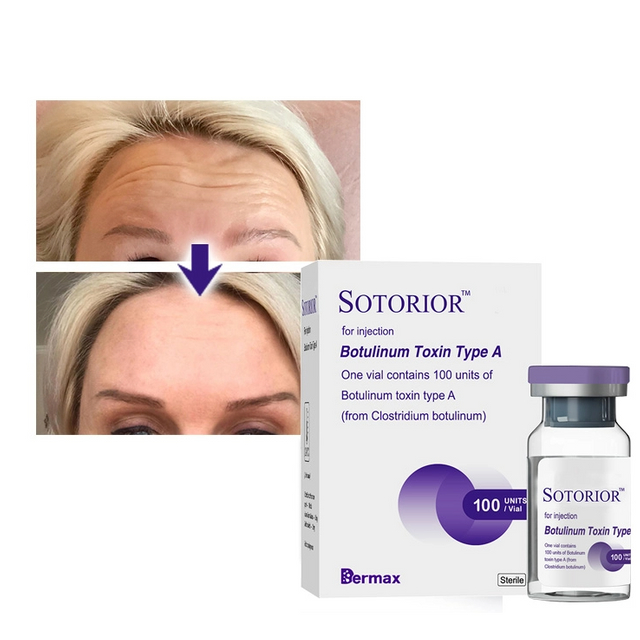 Sotorior® Toxina Botulínica Tipo A Para Arrugas Faciales
