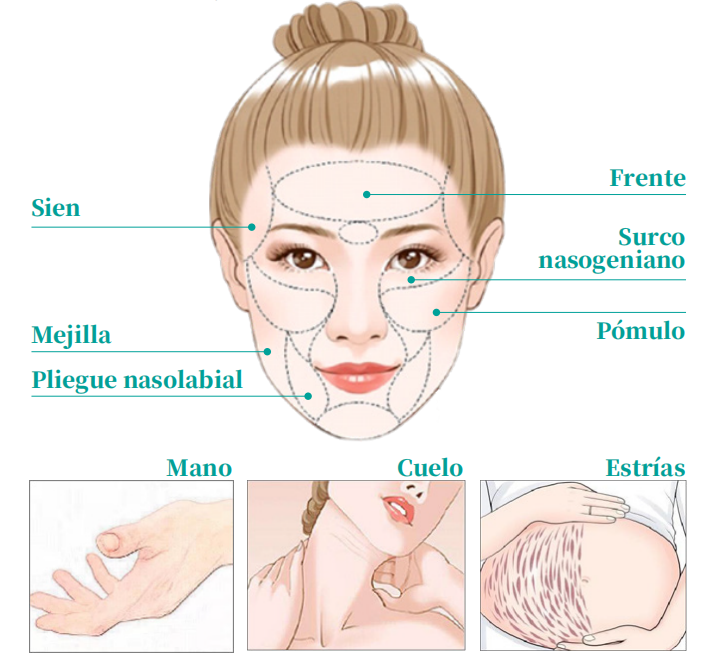 ácido poliláctico precio