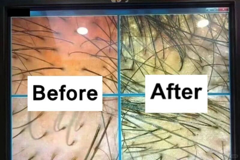 exosomas capilares antes y despu&eacute;s