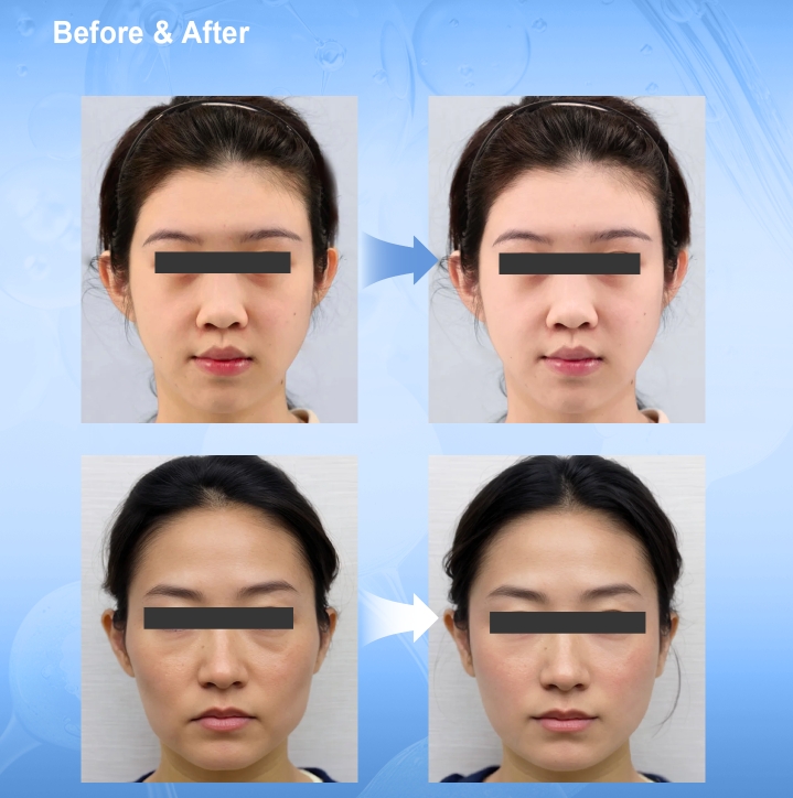 Inyección de hidratación de Mesocel HA para la cara antes y después