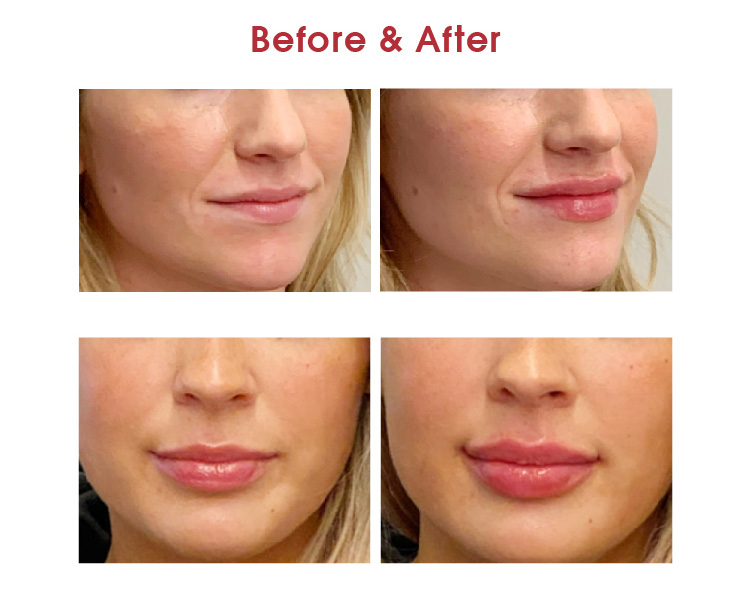 Aqua Secret Filler Smoocy 2 ml de relleno de labios en venta