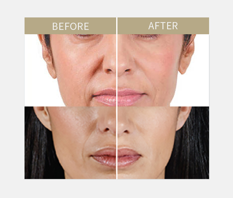 Luz de relleno secreto Aqua 2 ml de relleno dérmico 