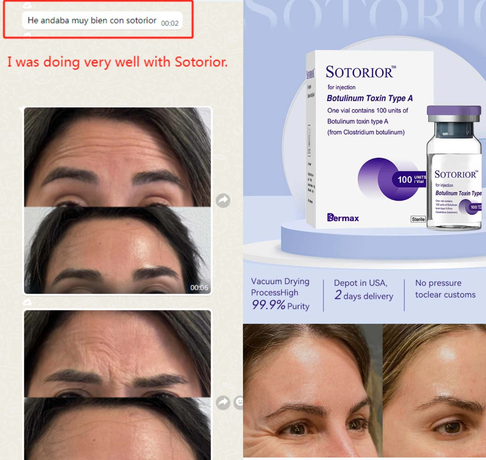 Toxina Botulínica Tipo A