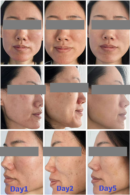 PDRN salm&oacute;n antes y despu&eacute;s