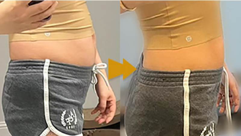 Inyecciones para quemar grasa abdominal