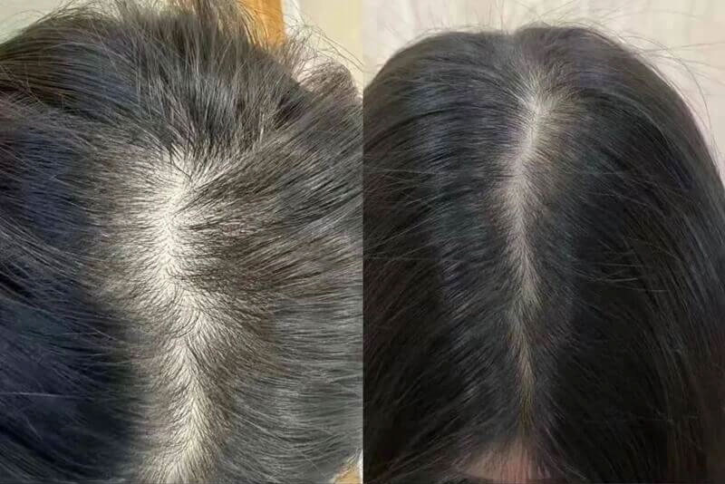 exosomas capilares antes y despu&eacute;s