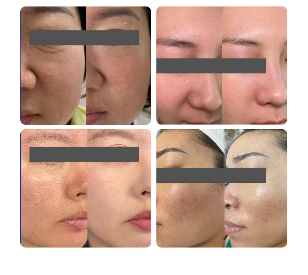 EXOBLOOM Exosomas tratamiento facial antes y después