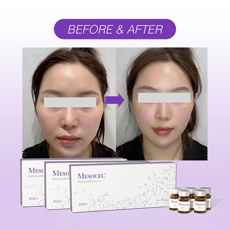 Qué es La Mesoterapia