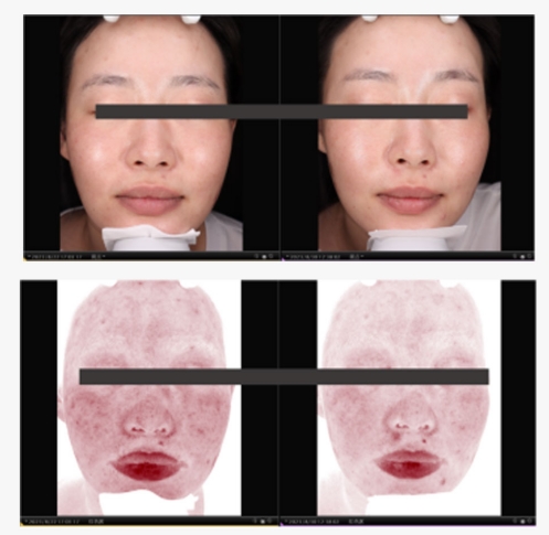 PDRN salm&oacute;n antes y despu&eacute;s