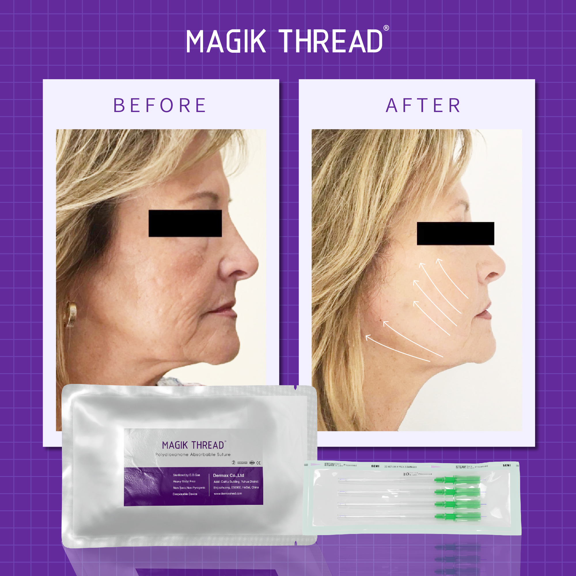 Las Mejores Marcas De Hilos PDO