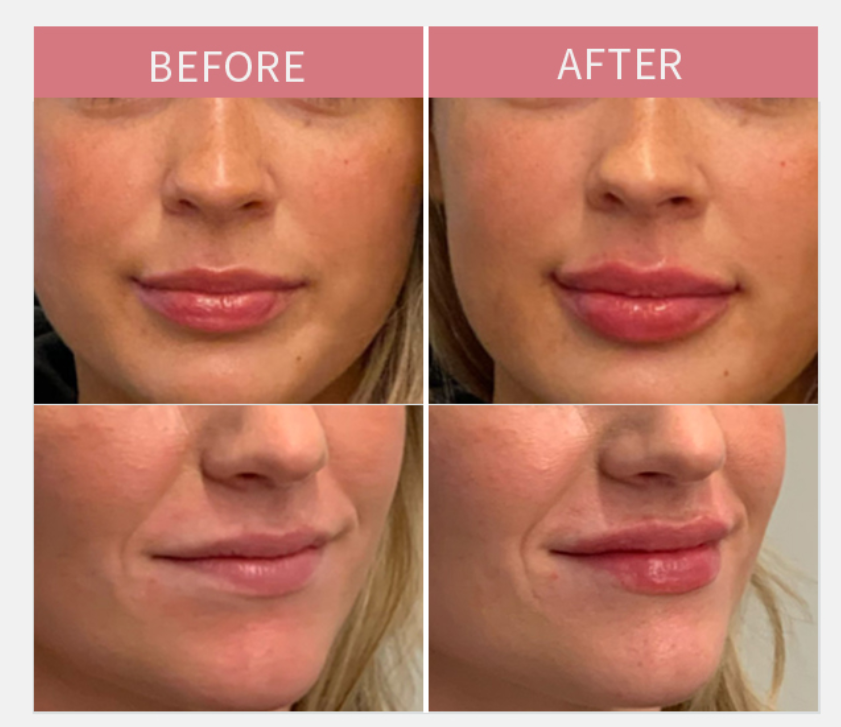 Inyección de labios de relleno dérmico de 1 ml