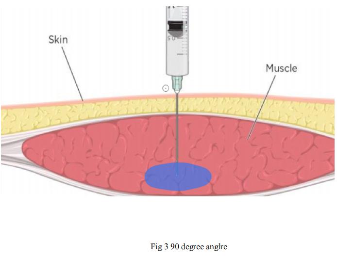 como se inyecta el acido hialuronico en gluteos