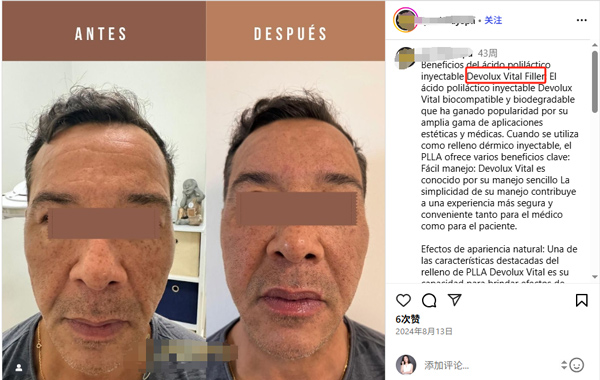 &aacute;cido polil&aacute;ctico antes y despu&eacute;s