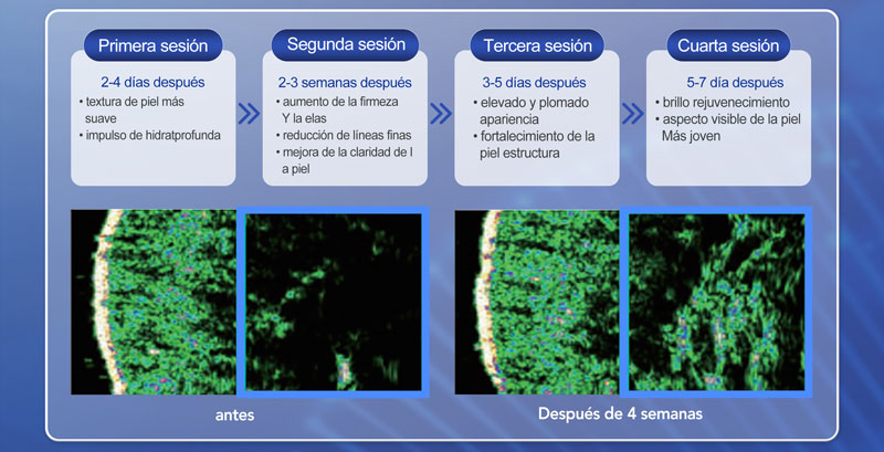 PN rejuvenecimiento facial
