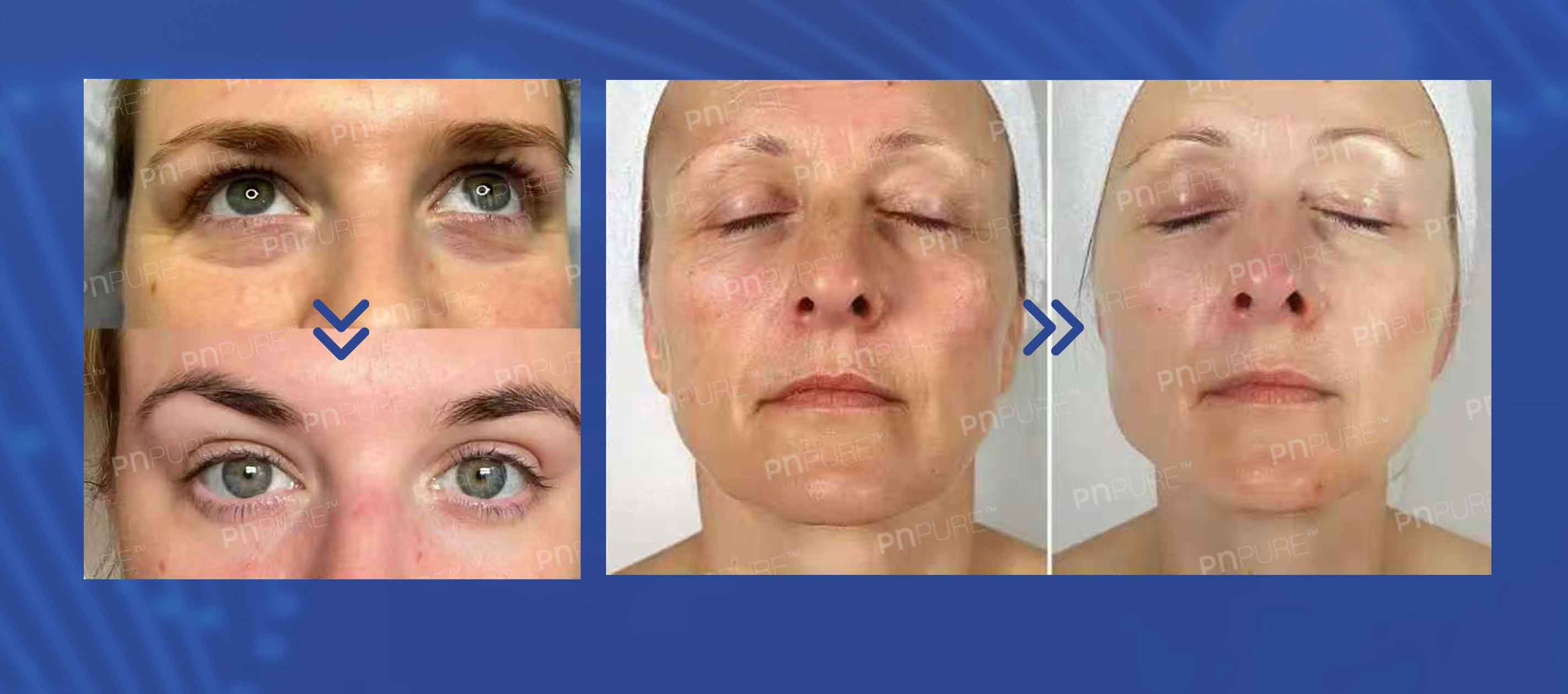 mejor tratamiento con polinucle&oacute;tidos para ojos