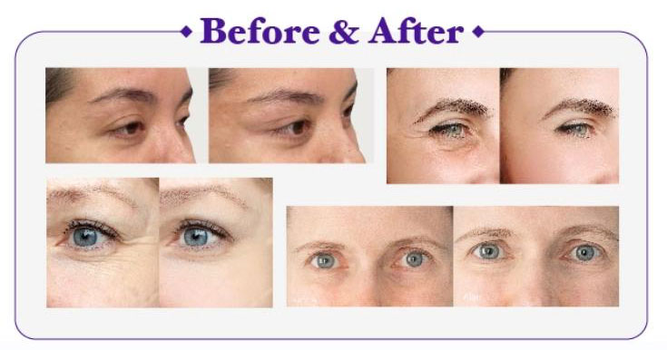 hilos pdo para ojeras
