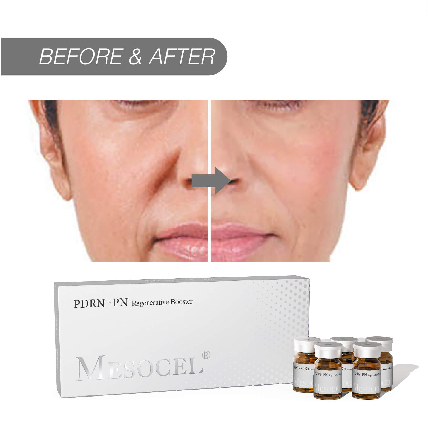 Mesoterapia Con PDRN Vs. Microneedling: Diferencias Clave