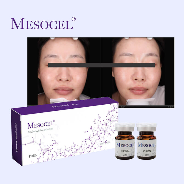 Mesocel® PDRN Para Cicatrices De Acné
