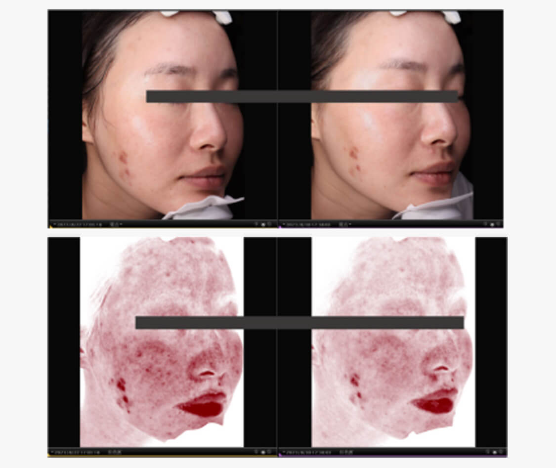 PDRN regeneraci&oacute;n