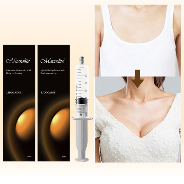 Macrolite®: Ácido Hialurónico En Senos Antes Y Después