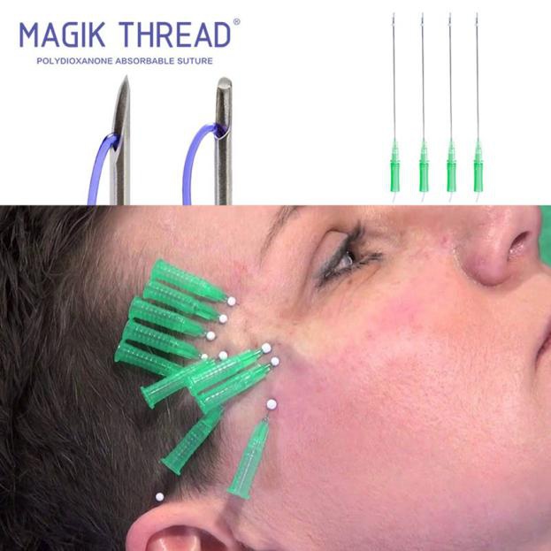 Levantamiento de Cejas con PDO