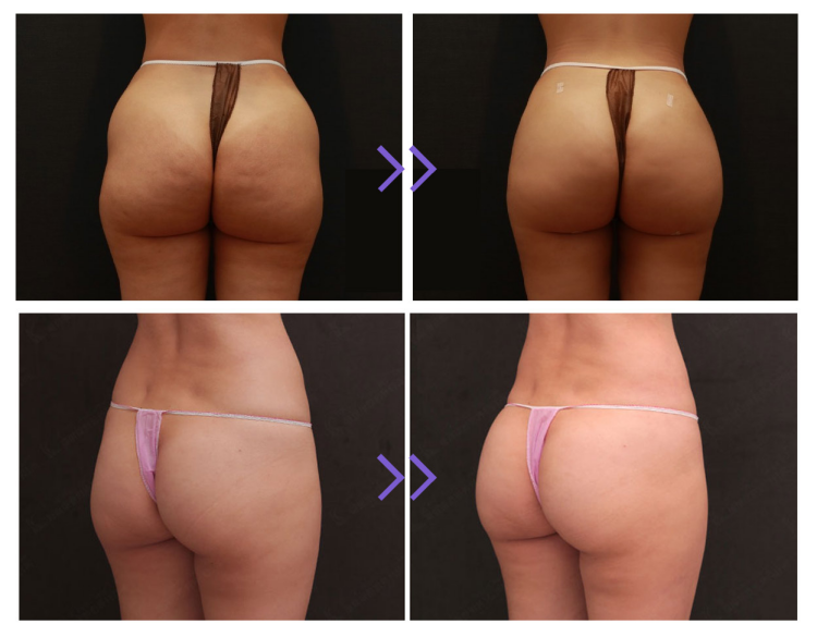 Ácido Poliláctico para Glúteos