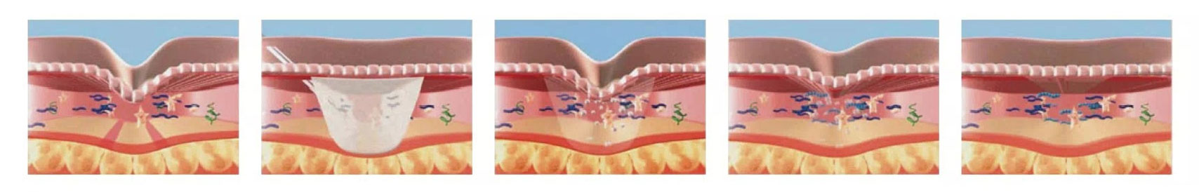 efectos del acido polilactico en la piel