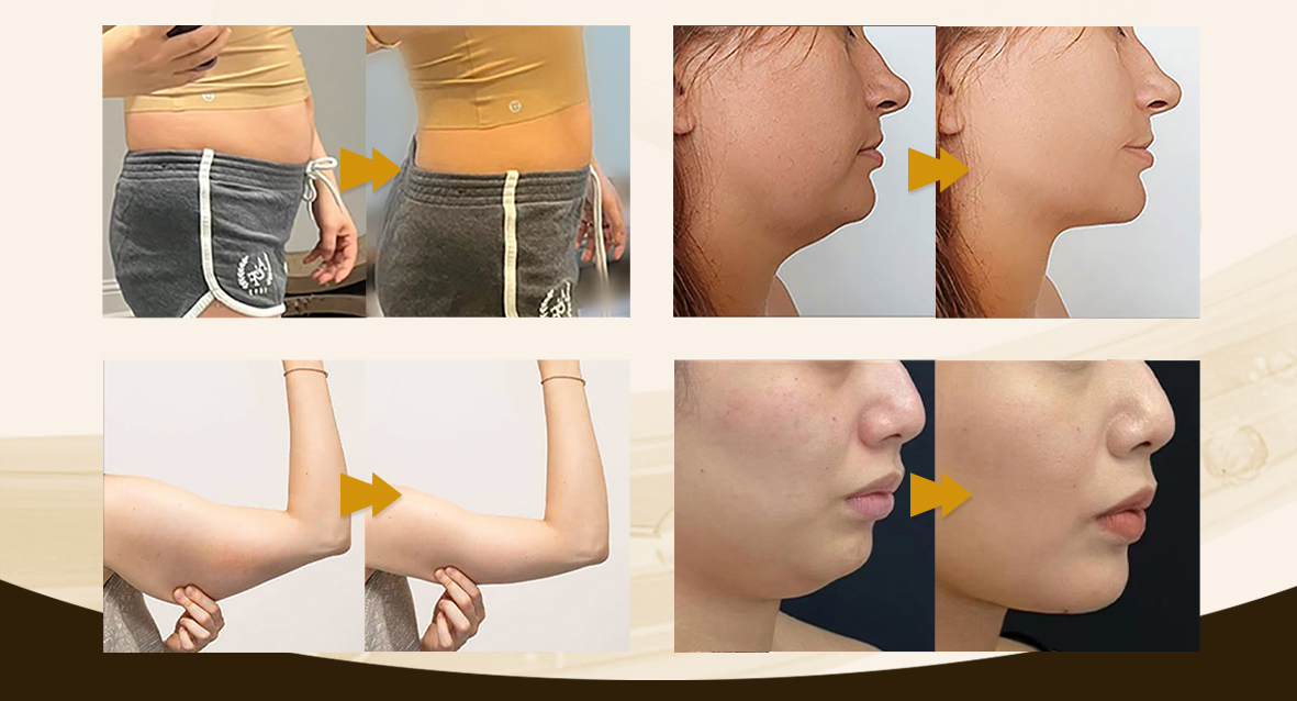 Solución Lipolítica