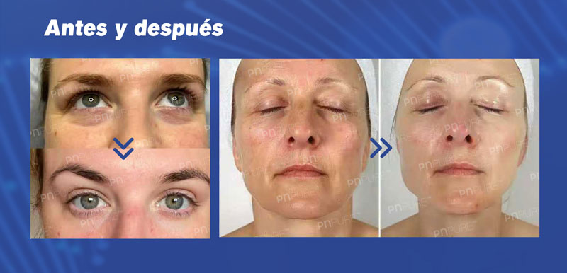 PN rejuvenecimiento facial
