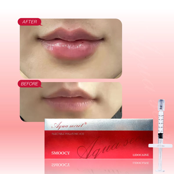 Ácido Hialurónico en Labios Antes y Después: Resultados y Cambios Esperados