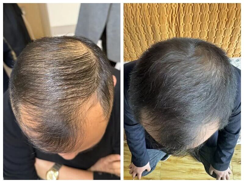 Alopecla Con Exosomas
