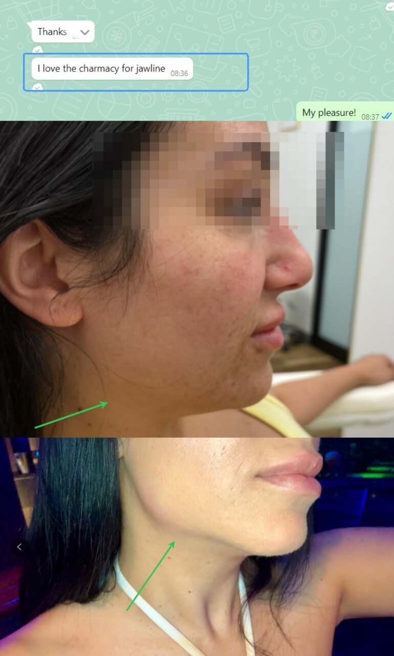 hidroxiapatita de calcio antes y despu&eacute;s