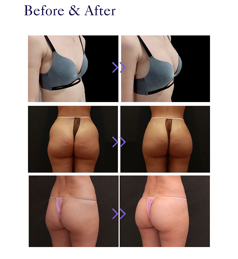 aumento de gluteos con acido polilactico