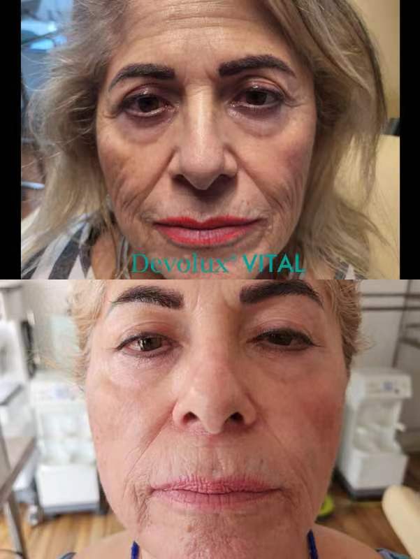 &aacute;cido polil&aacute;ctico antes y despu&eacute;s