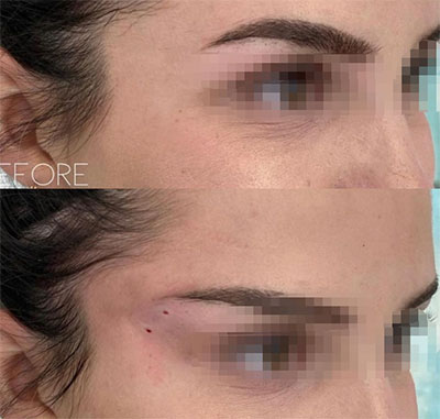 Levantamiento de Cejas con PDO