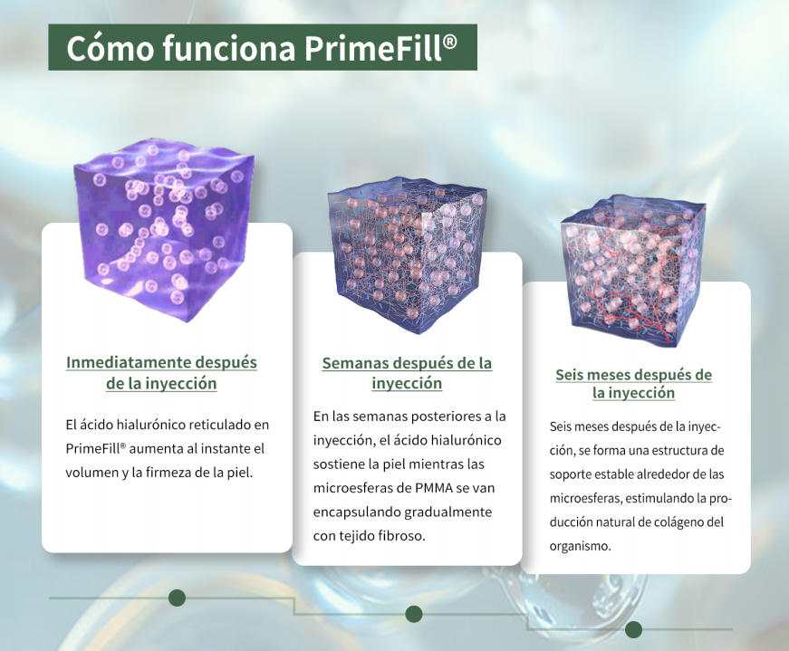 ¿Cómo funciona PrimeFill® Jeringa de llenado de PMMA?