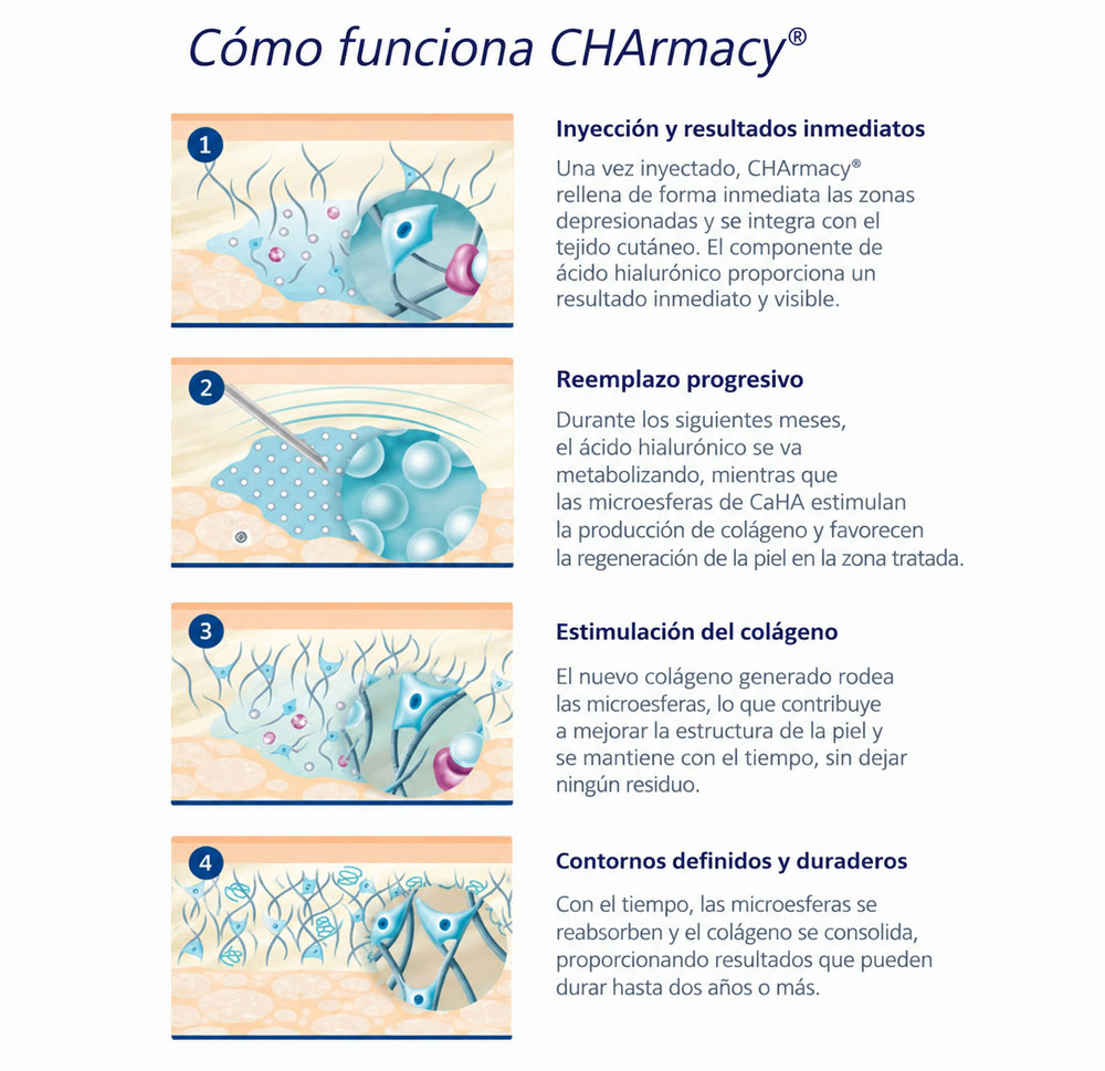 C&oacute;mo funcionan los rellenos de tejido blando de hidroxiapatita de calcio CHArmacy&reg;